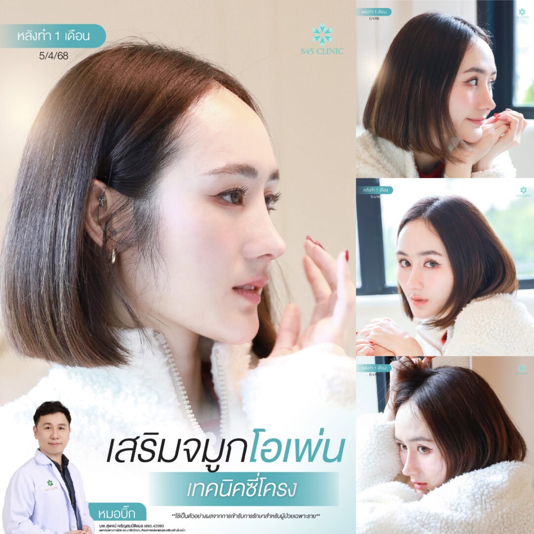 ทรงจมูก B-Nose หมอบิ๊ก
