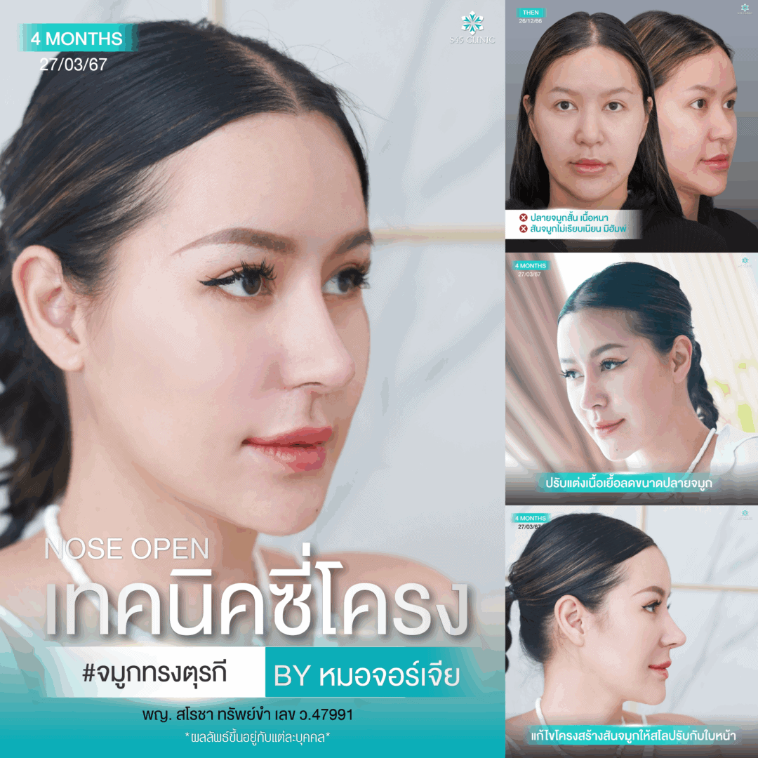 ทรงจมูกตุรกี หมอจอร์เจีย S45 Clinic