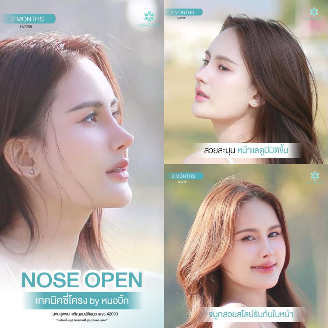 ทรงจมูก B-Nose หมอบิ๊ก