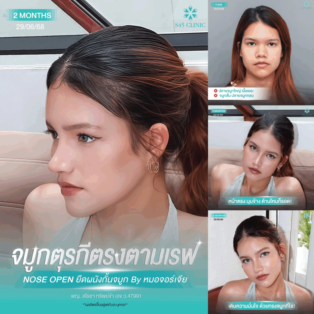 ทรงจมูกตุรกี หมอจอร์เจีย S45 Clinic