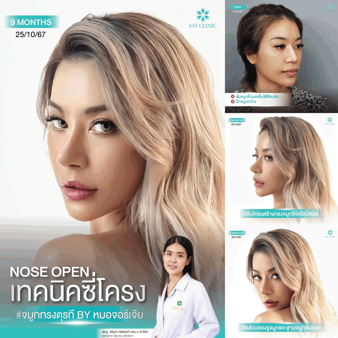 ทรงจมูกตุรกี หมอจอร์เจีย S45 Clinic