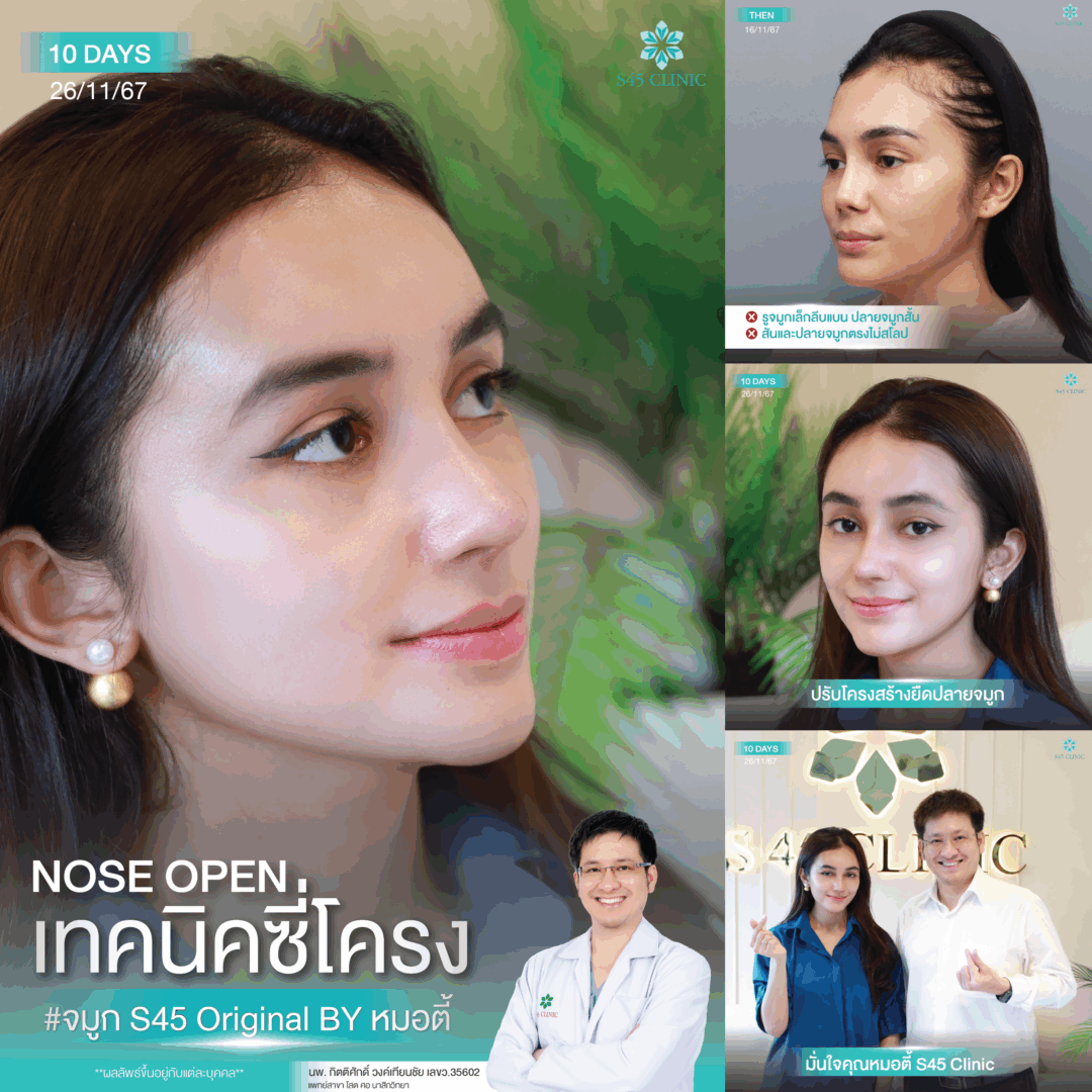 แก้จมูก หมอตี้ S45 Original