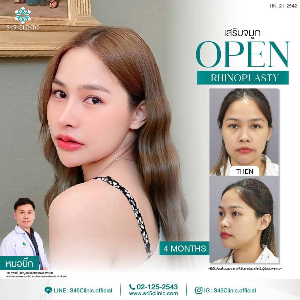 เสริมจมูก หมอบิ๊ก S45 Clinic