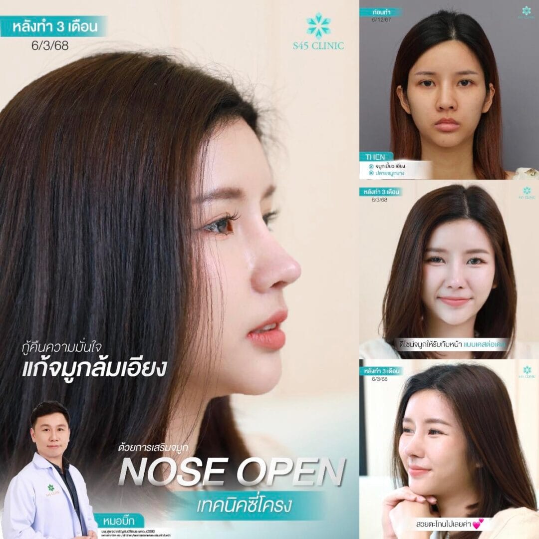 เสริมจมูก หมอบิ๊ก S45 Clinic