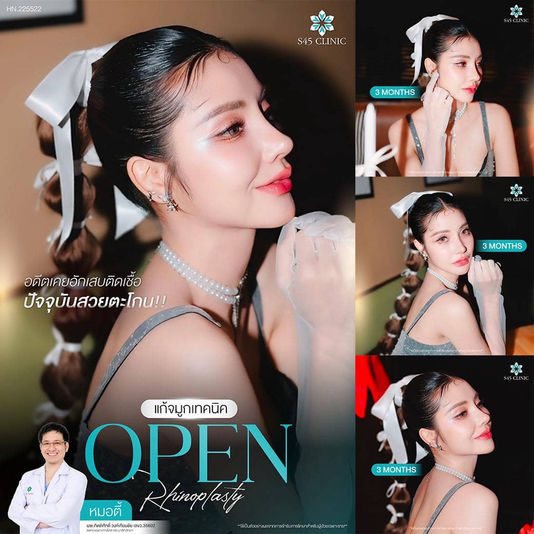 แก้จมูก หมอตี้ S45 Original