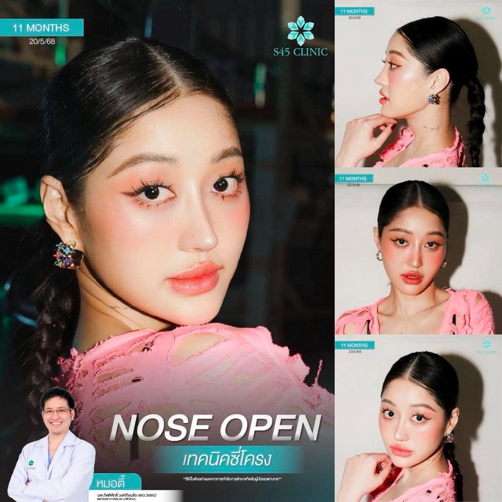 แก้จมูก หมอตี้ S45 Original