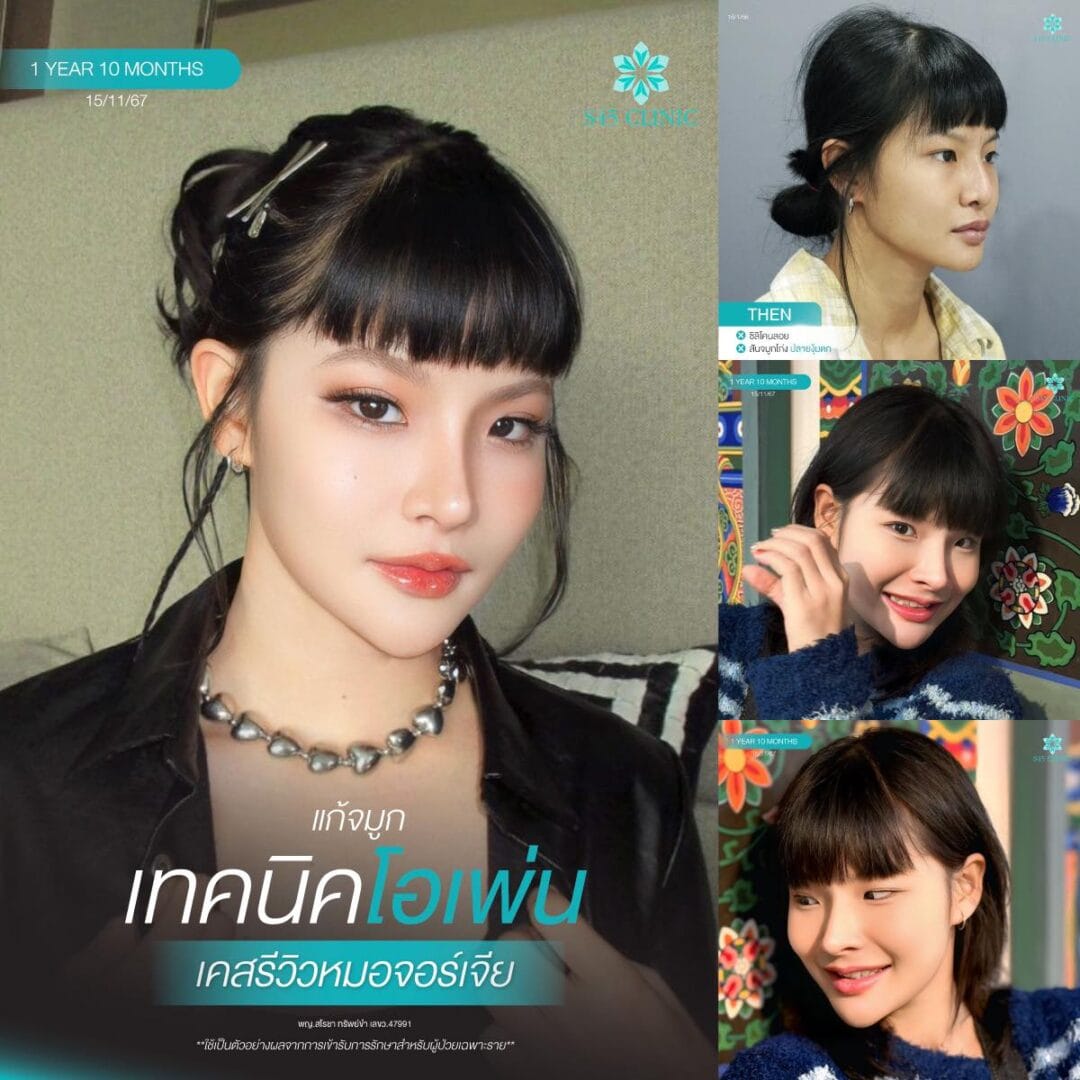 ทรงจมูก B-Nose หมอบิ๊ก