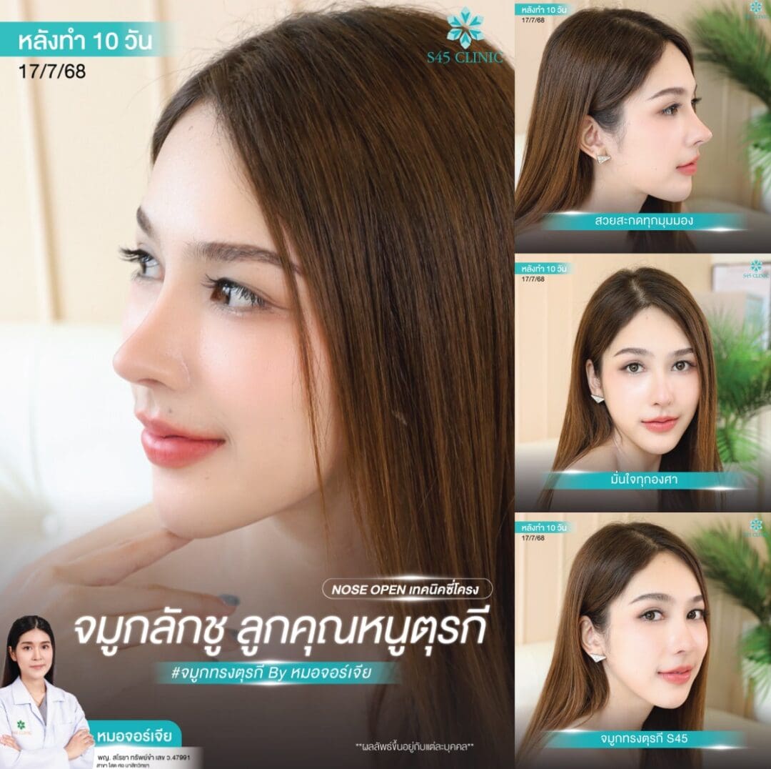 ทรงจมูก B-Nose หมอบิ๊ก