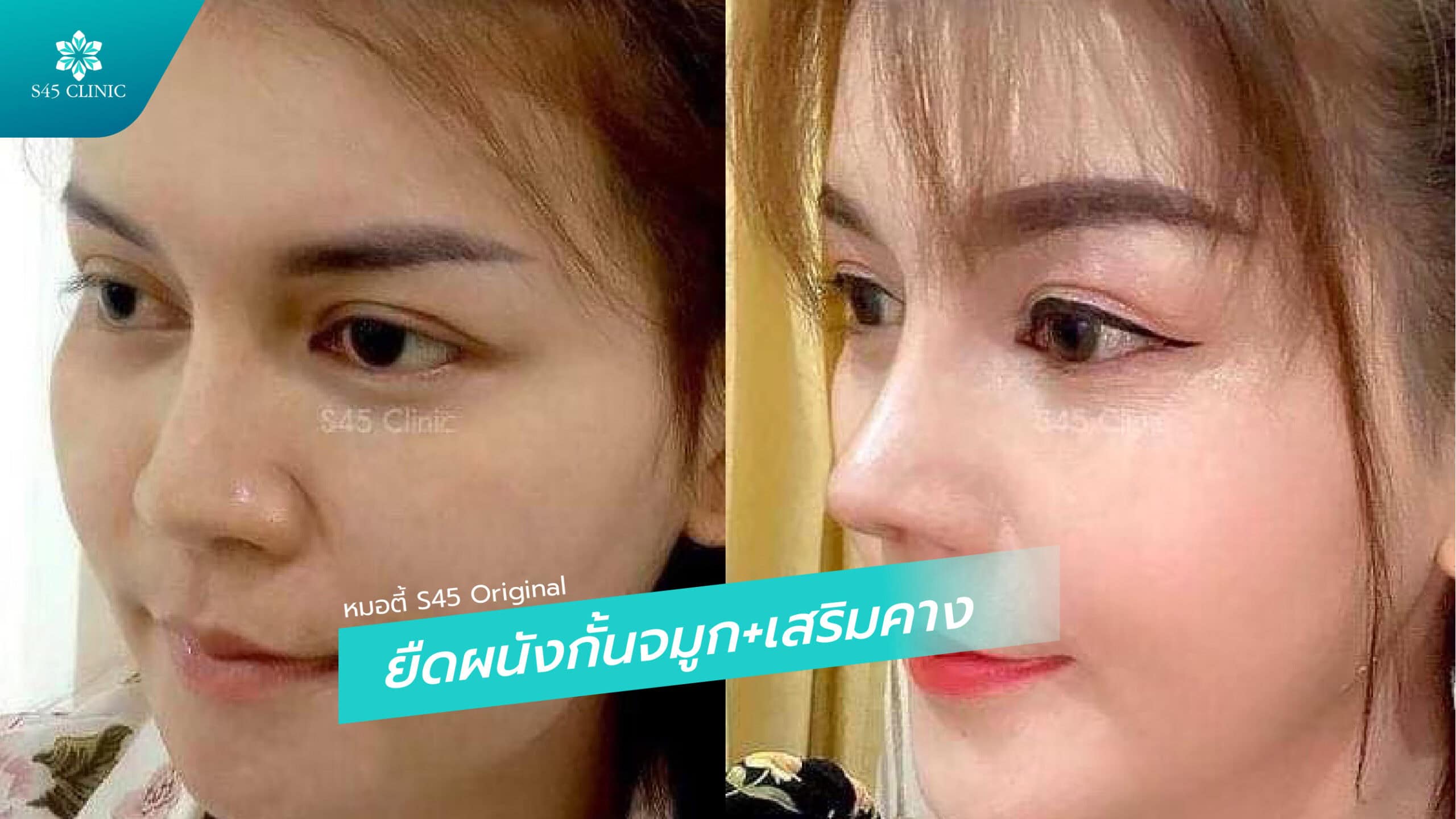 เสริมจมูก เสริมคาง