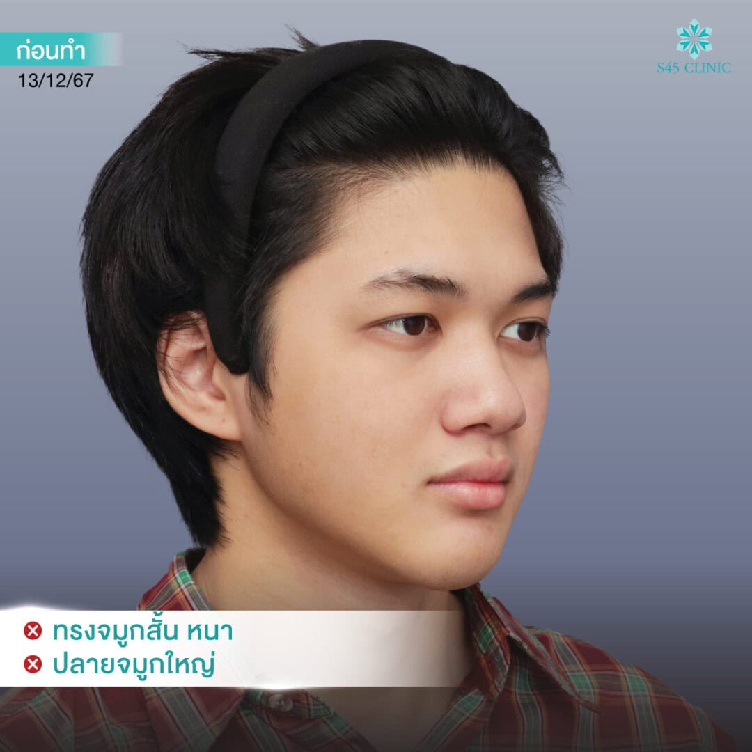 ทรงจมูกผู้ชาย