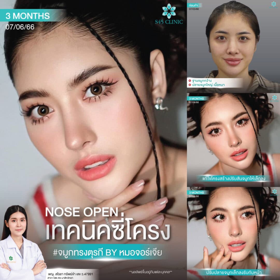 ทรงจมูก B-Nose หมอบิ๊ก