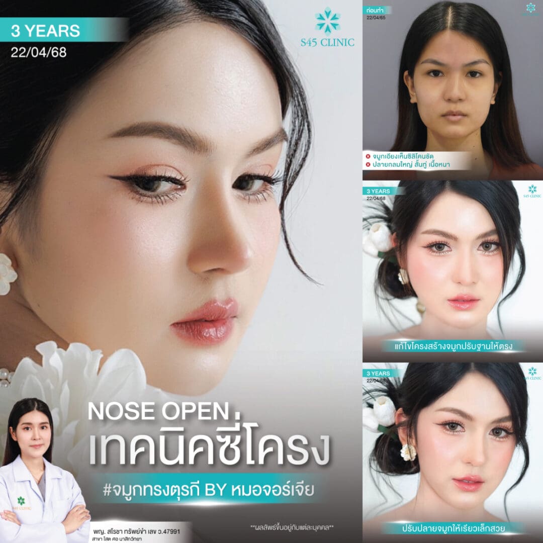 ทรงจมูก B-Nose หมอบิ๊ก
