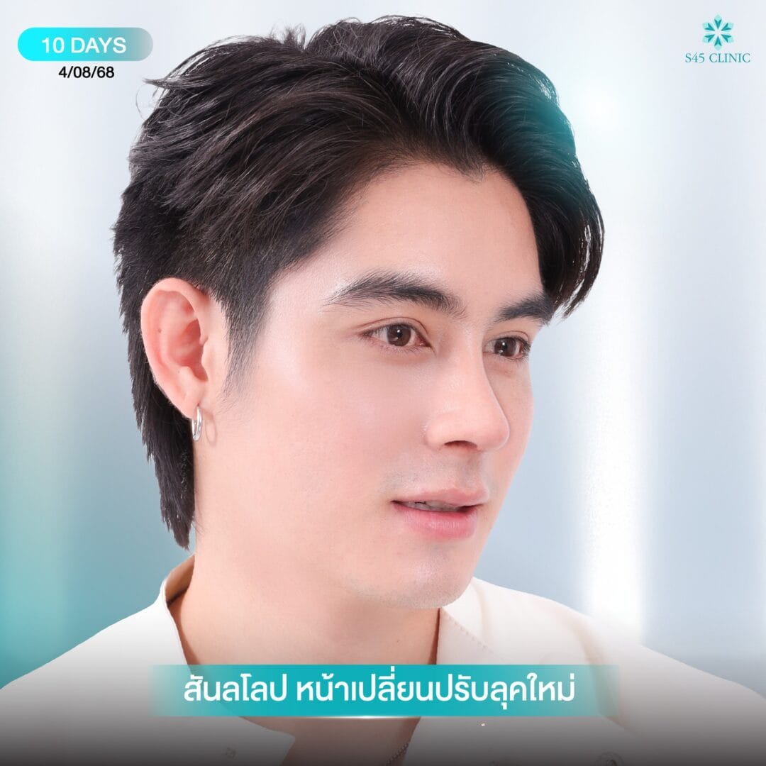 เสริมจมูกผู้ชาย หมอเช S45 clinic