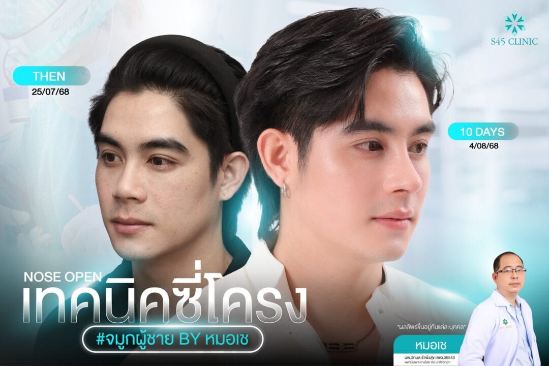 เสริมจมูกผู้ชาย หมอเช S45 clinic