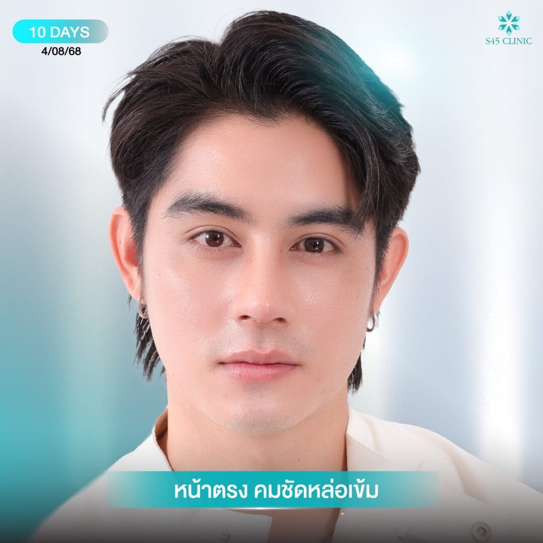 เสริมจมูกผู้ชาย หมอเช S45 clinic