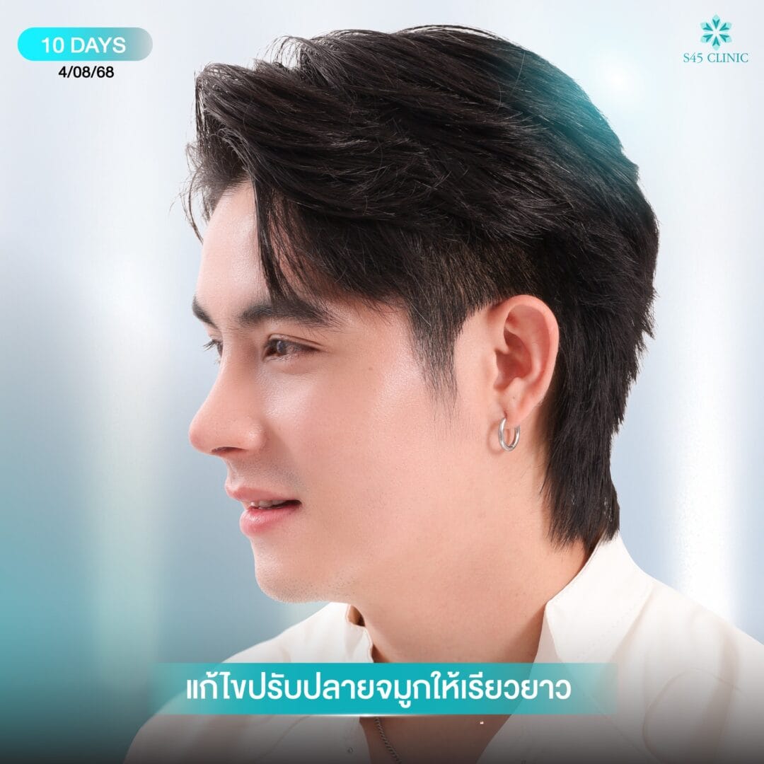 เสริมจมูกผู้ชาย หมอเช S45 clinic