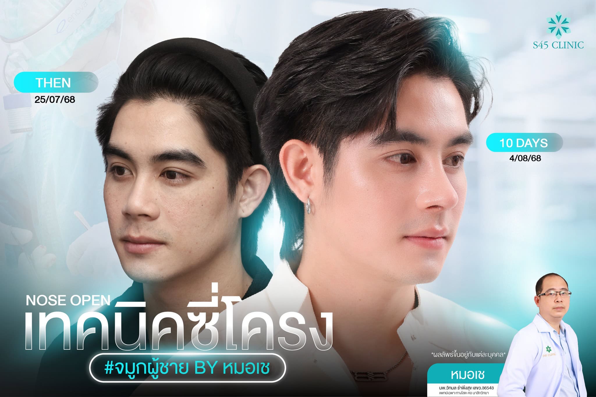 เสริมจมูกผู้ชาย หมอเช S45 clinic