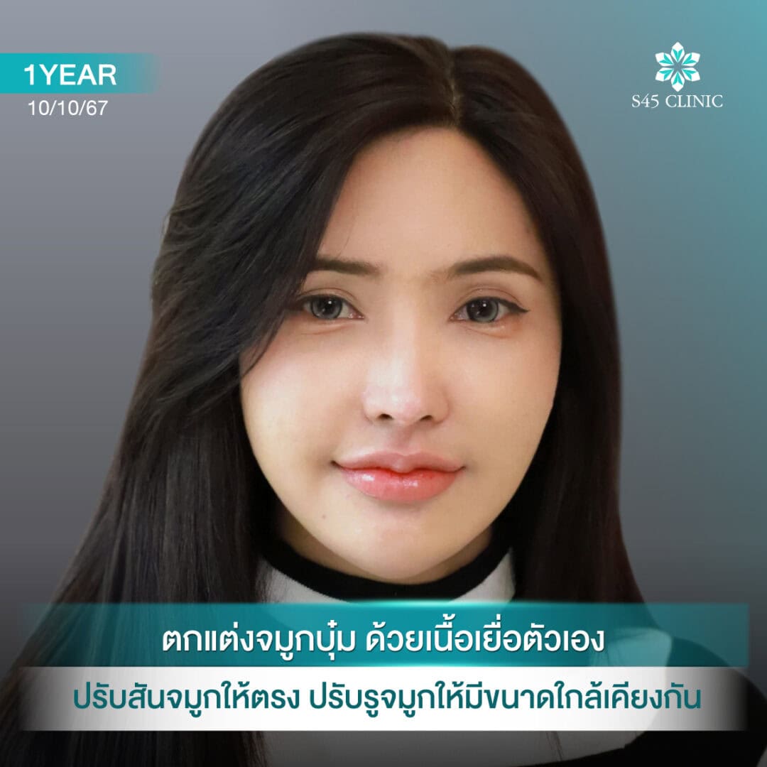 แก้จมูก หดรั้ง หมอตี้ S45 Original