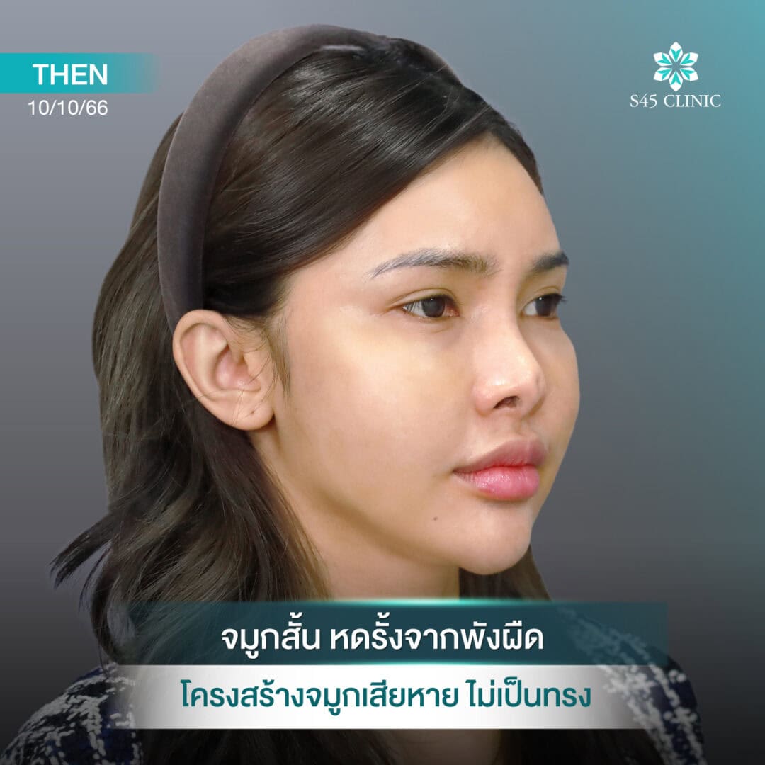 แก้จมูก หดรั้ง หมอตี้ S45 Original