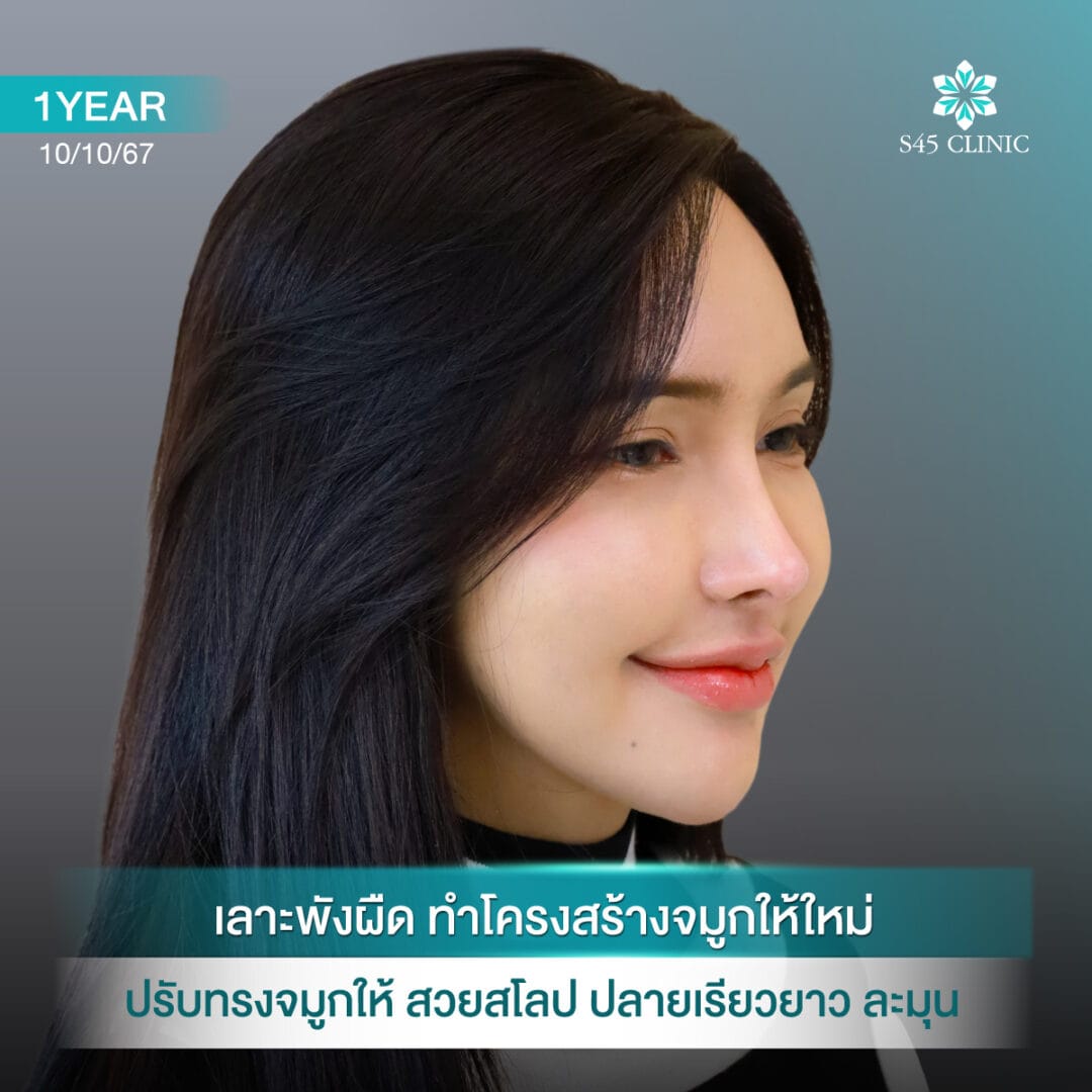 แก้จมูก หดรั้ง หมอตี้ S45 Original