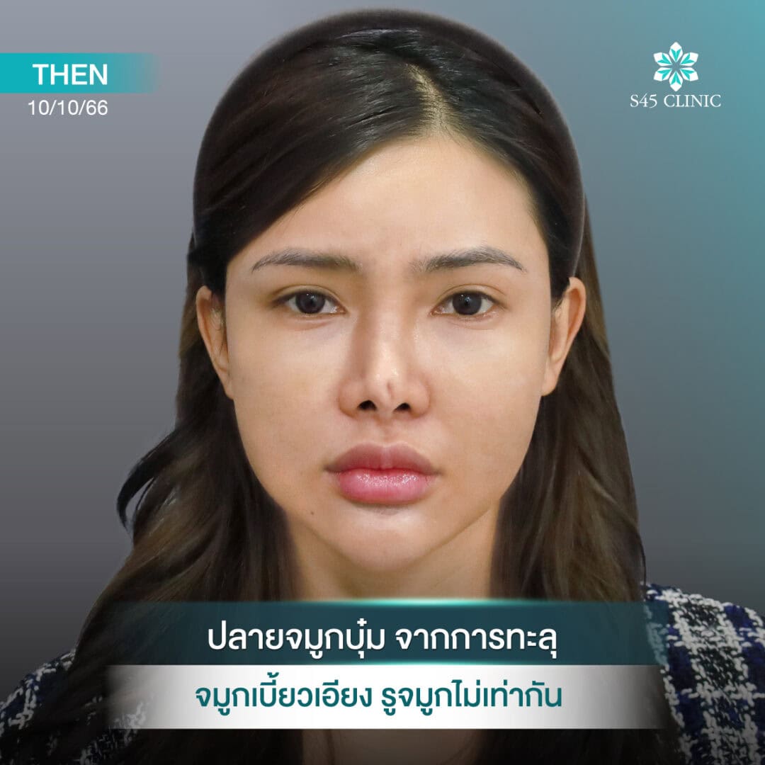 แก้จมูก หดรั้ง หมอตี้ S45 Original