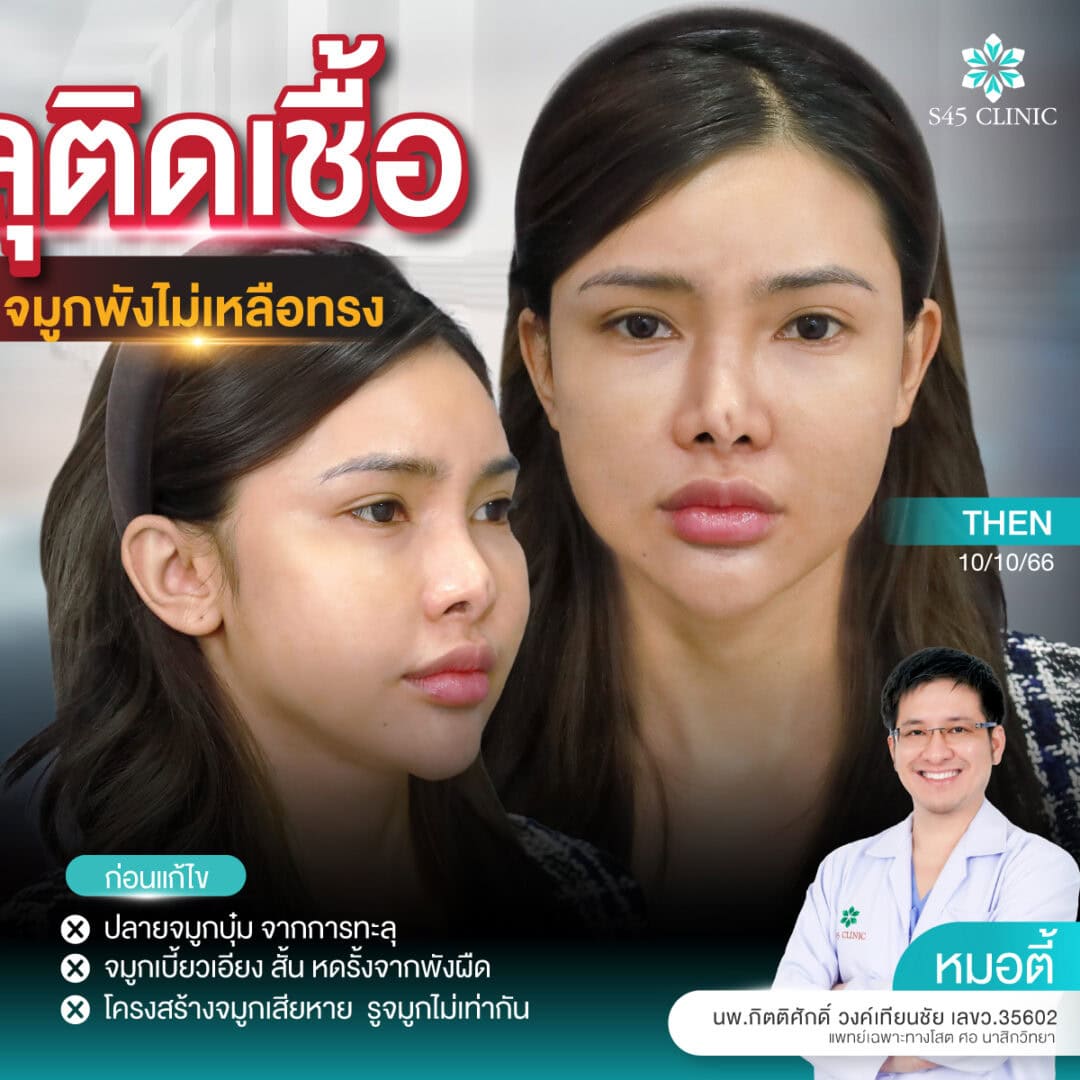 แก้จมูก หมอตี้ S45 original