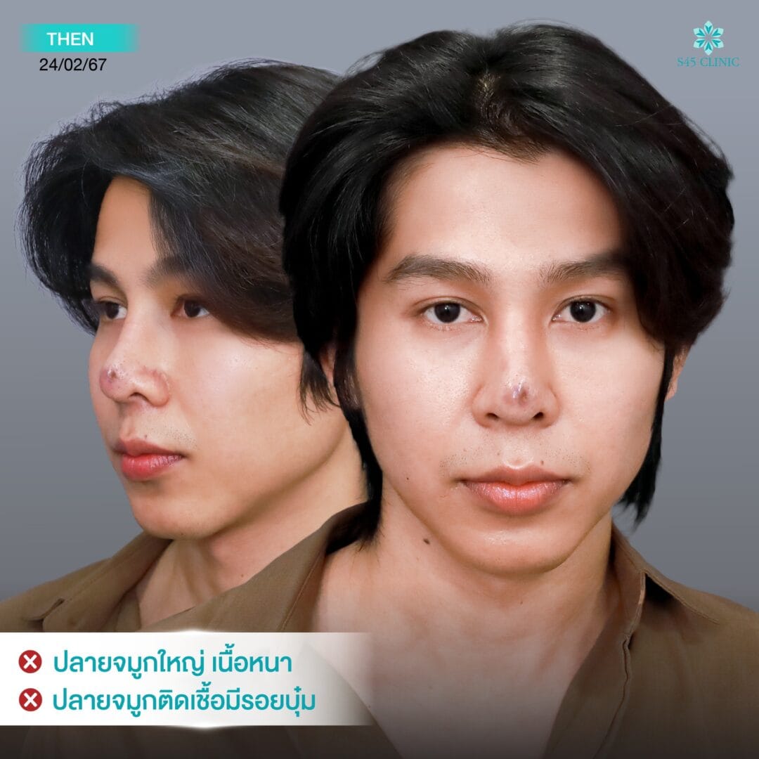 แก้จมูกผู้ชาย หมอเช S45 Clinic 2