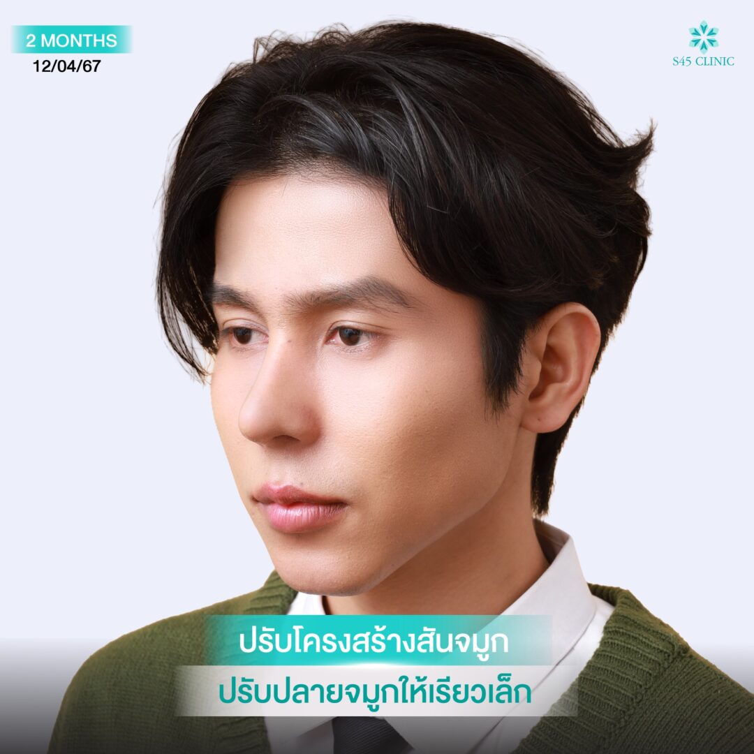 แก้จมูกผู้ชาย หมอเช S45 Clinic 2