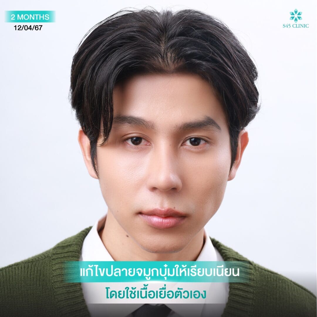 แก้จมูกผู้ชาย หมอเช S45 Clinic 2