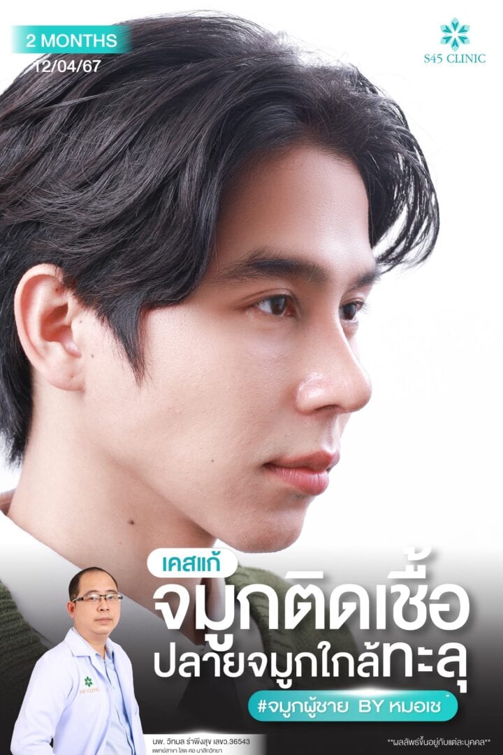 แก้จมูกผู้ชาย หมอเช S45 Clinic 