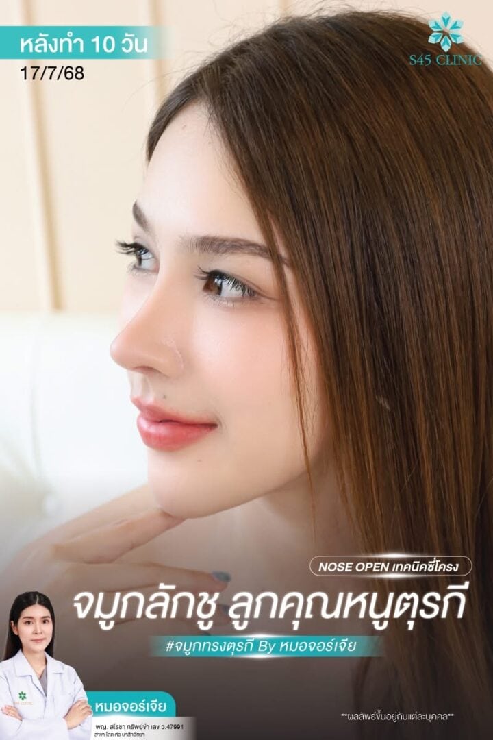 Rhinoplasty Secret:เสริมจมูกด้วยกระดูกอ่อนคนอื่น ได้ไหม 4 จมูกตุรกี