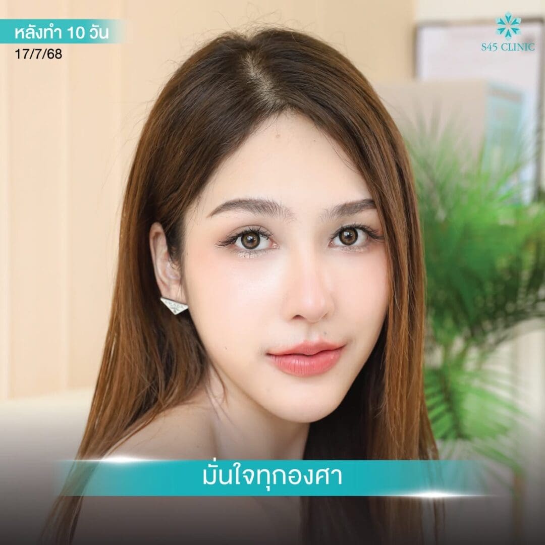 Rhinoplasty Secret:เสริมจมูกด้วยกระดูกอ่อนคนอื่น ได้ไหม 2 จมูกทรงตุรกี