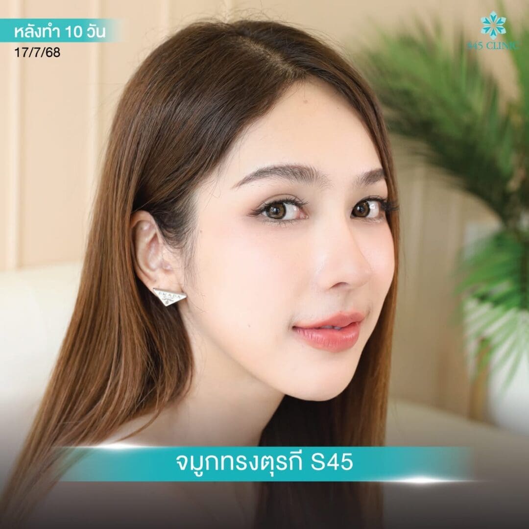 Rhinoplasty Secret:เสริมจมูกด้วยกระดูกอ่อนคนอื่น ได้ไหม 3 จมูกทรงตุรกี