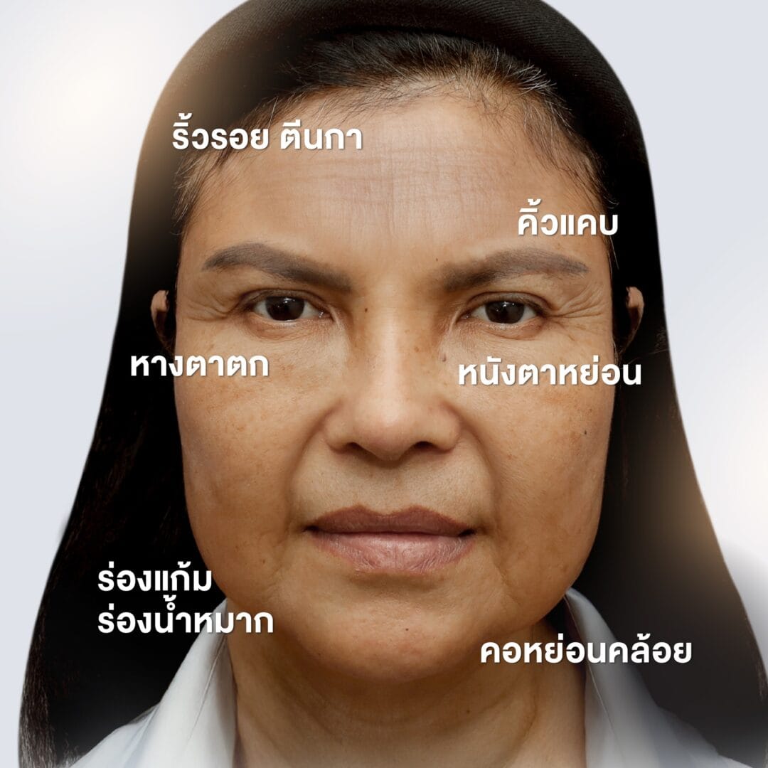 endotine