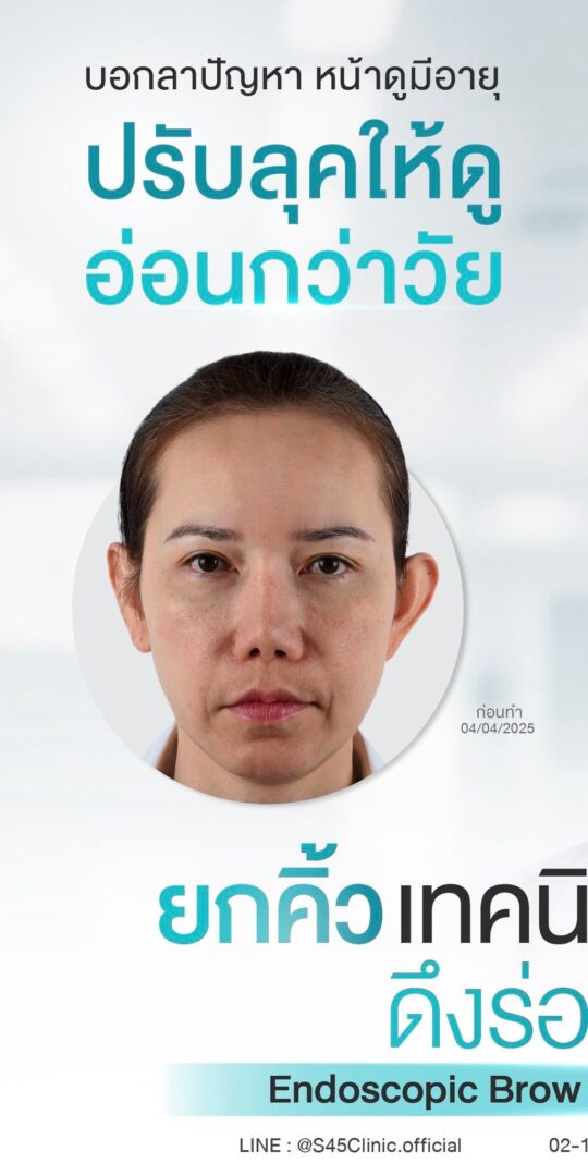 endotine