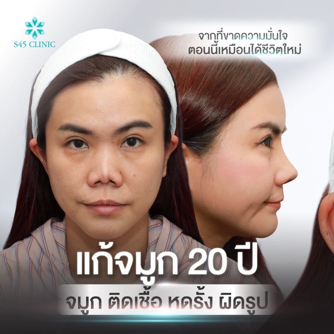 ทรงจมูก B-nose