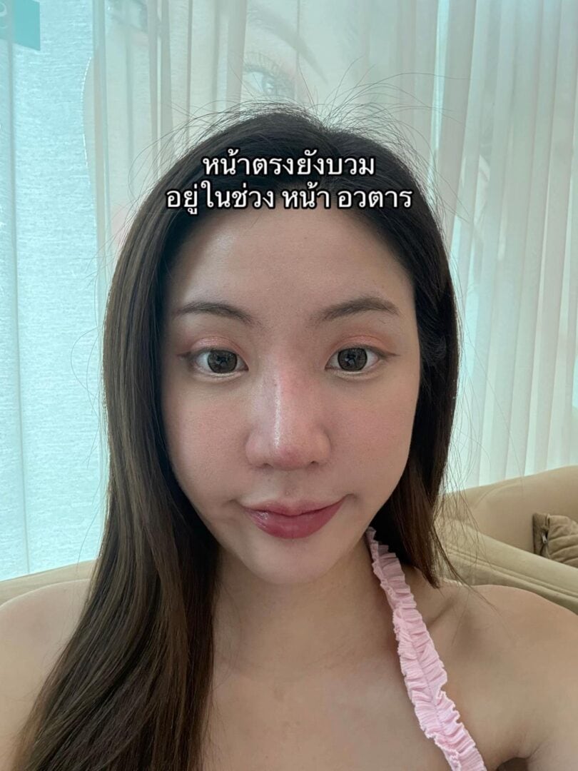 ทรงจมูก RosyNose