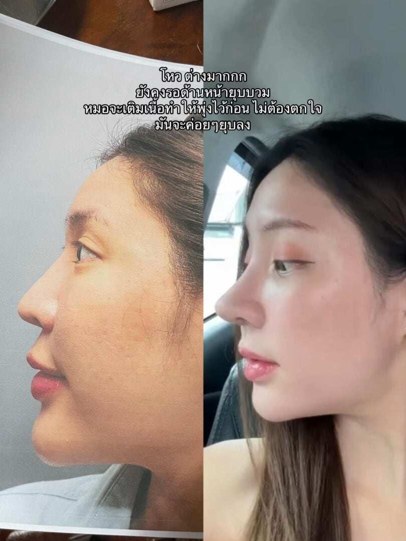 ทรงจมูก RosyNose