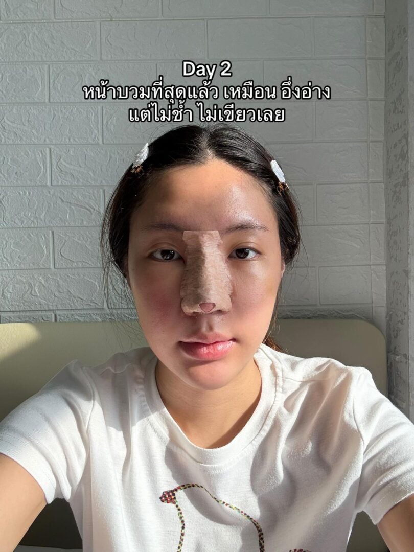 ทรงจมูก RosyNose