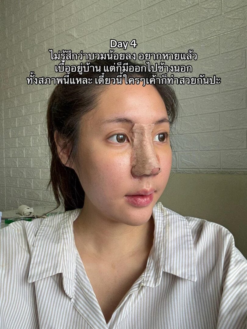 ทรงจมูก RosyNose