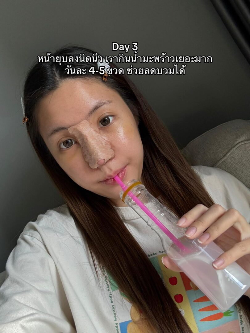 ทรงจมูก RosyNose