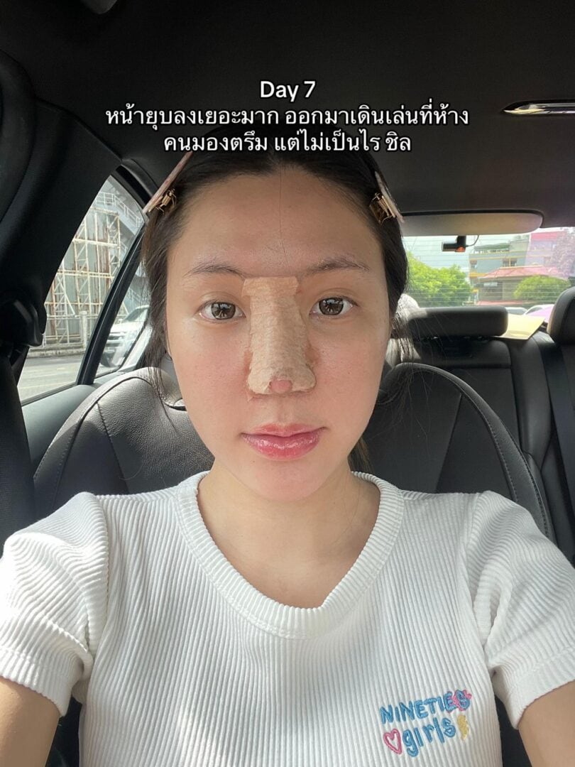 ทรงจมูก RosyNose