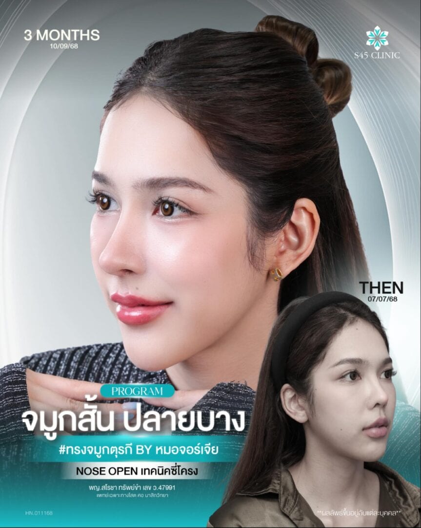 ทรงจมูกตุรกี หมอจอร์เจีย