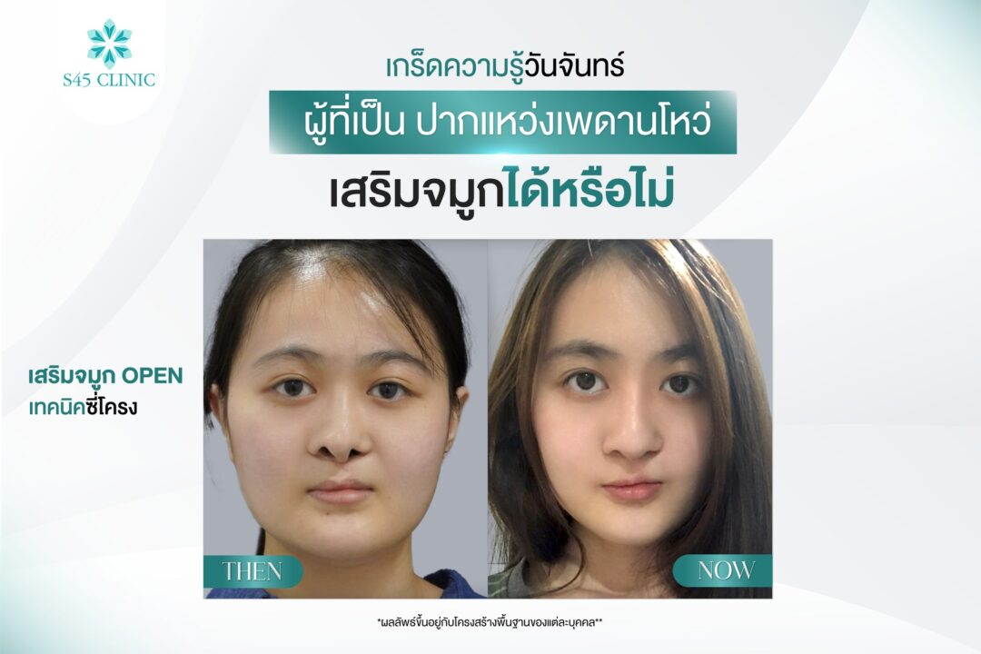 แก้จมูก หมอตี้ ปากแหว่งเพดานโหว่