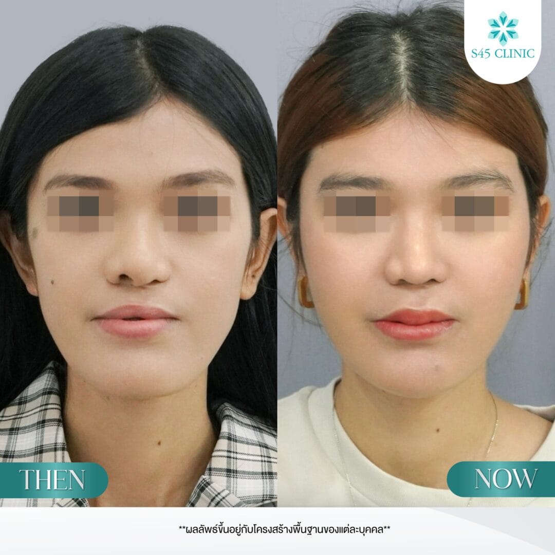 Restore & Refine รักษาปากแหว่งเพดานโหว่ก่อนเสริม 6 แก้จมูก หมอตี้ ปากแหว่งเพดานโหว่