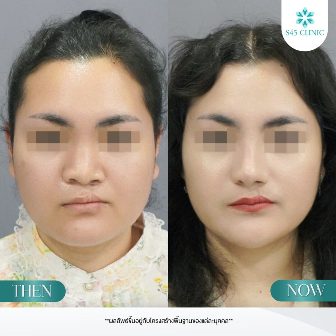Restore & Refine รักษาปากแหว่งเพดานโหว่ก่อนเสริม 7 แก้จมูก หมอตี้ ปากแหว่งเพดานโหว่