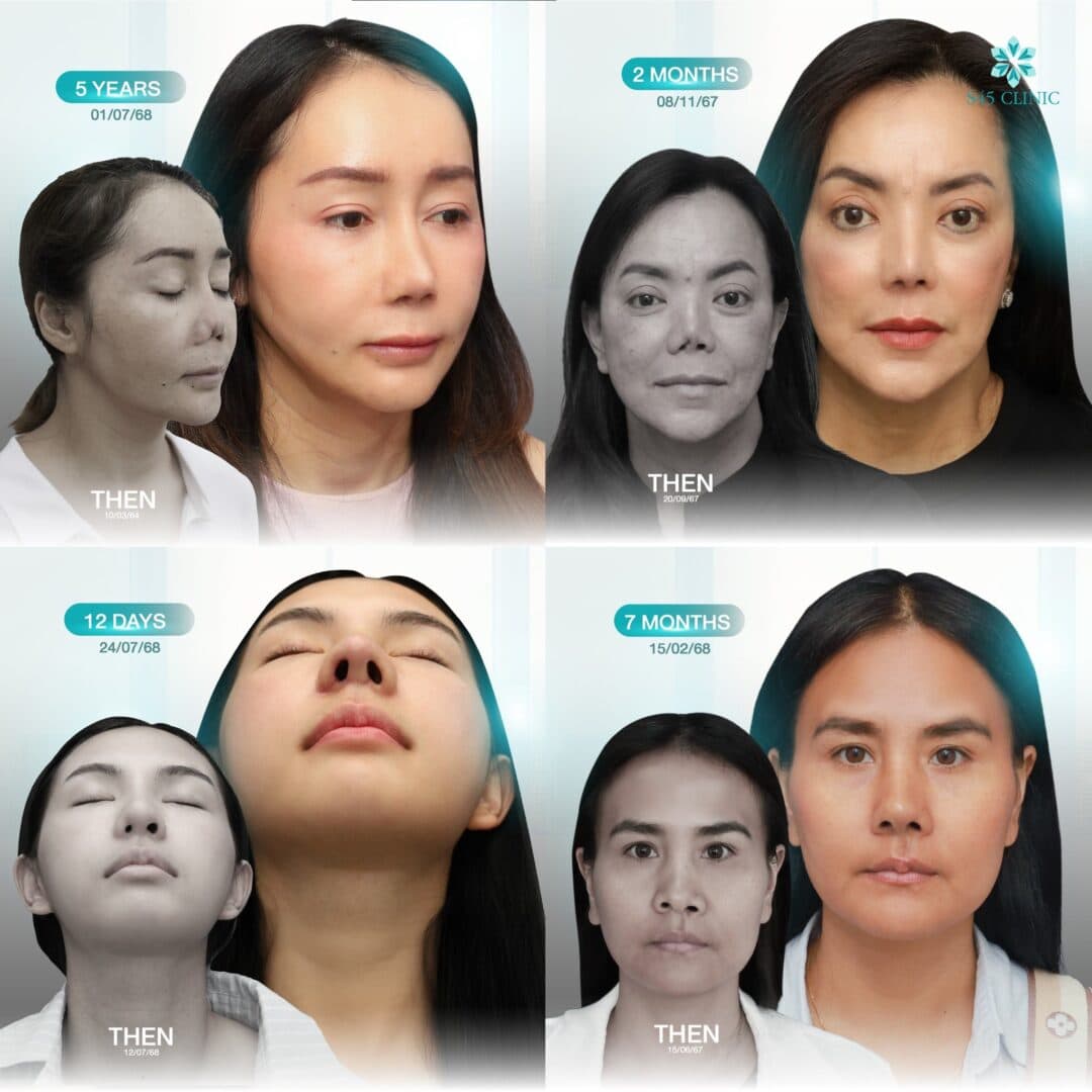 จมูกเหยี่ยว (Hawk Nose) แก้ทรงจมูกให้เข้ากับใบหน้า 5