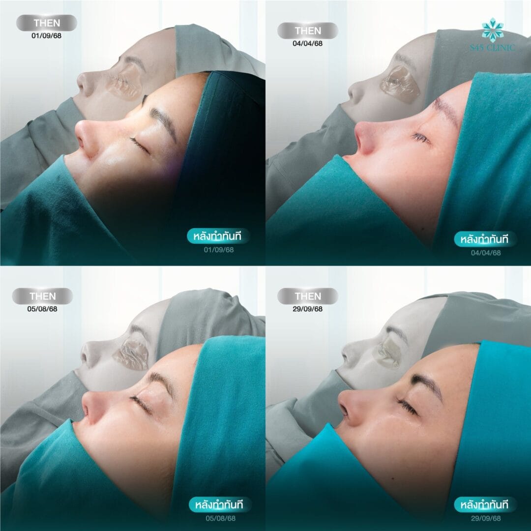 จมูกเหยี่ยว (Hawk Nose) แก้ทรงจมูกให้เข้ากับใบหน้า 6
