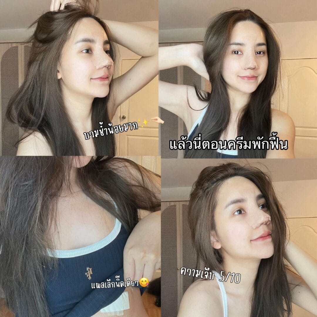 Balanced Nose Line ปรับรูจมูกให้ดูรับกับใบหน้ามากขึ้น 12 แก้จมูก หมอบิ๊ก s45 clinic