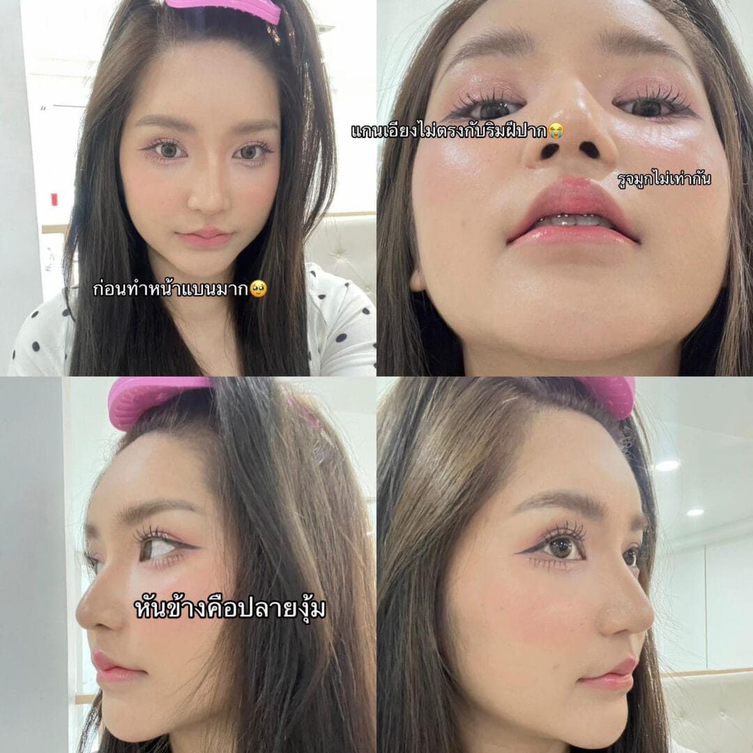 Balanced Nose Line ปรับรูจมูกให้ดูรับกับใบหน้ามากขึ้น 5 แก้จมูก หมอบิ๊ก s45 clinic